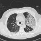 Atypical pneumonia, influenza, H1N1: CT - Computed tomography